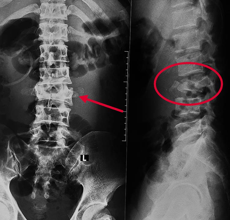 hình ảnh thoái hóa cột sống thắt lưng - Image 2