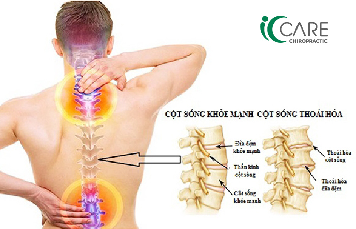 hình ảnh thoái hóa cột sống thắt lưng - Image 3