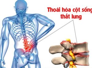 hình ảnh thoái hóa cột sống thắt lưng