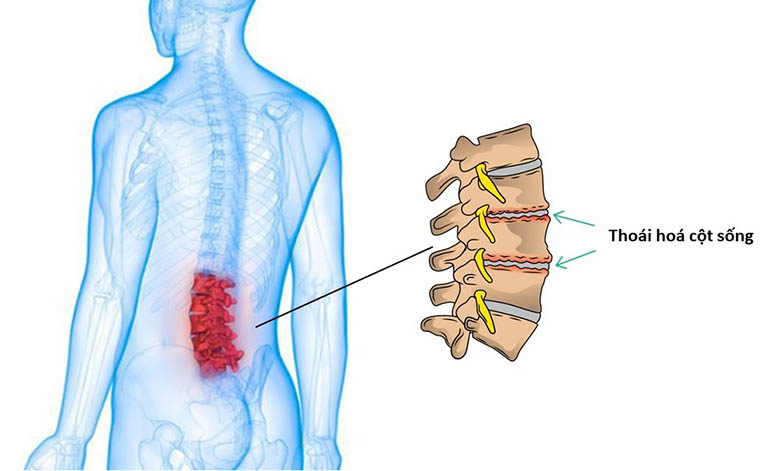 hình ảnh thoái hóa cột sống thắt lưng - Image 4
