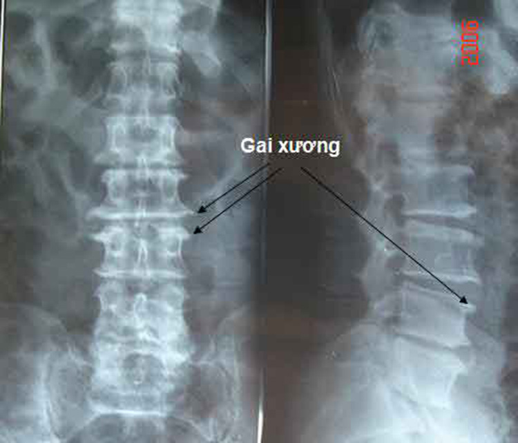 hình ảnh thoái hóa cột sống thắt lưng - Image 5