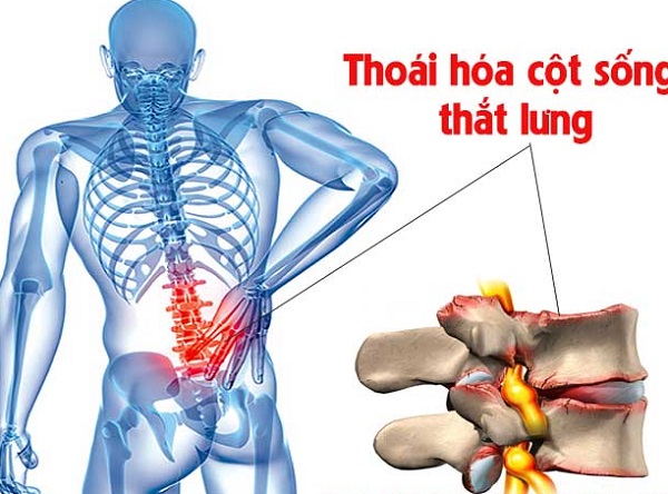hình ảnh thoái hóa cột sống thắt lưng