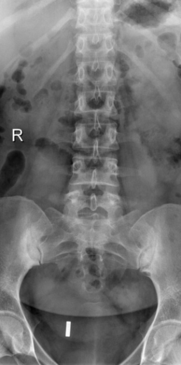 hình ảnh viêm khớp cùng chậu - Image 3