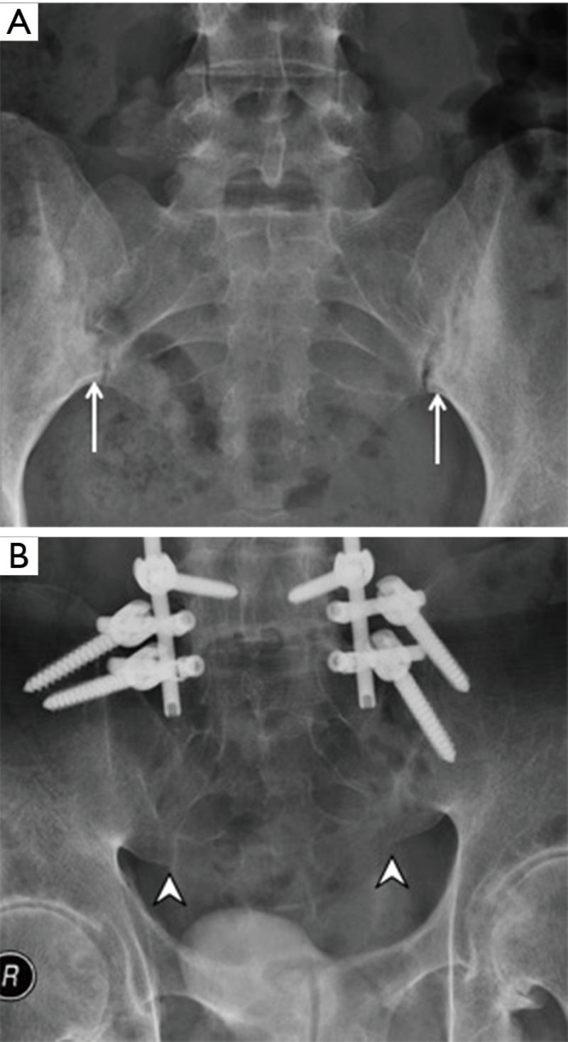 hình ảnh viêm khớp cùng chậu - Image 5