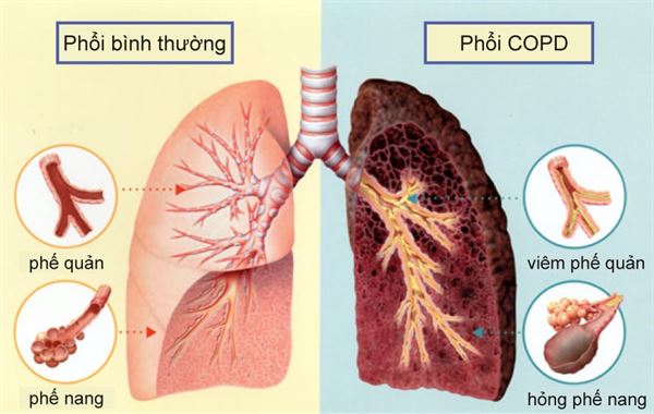 ho có đờm ở người bệnh copd - Image 4