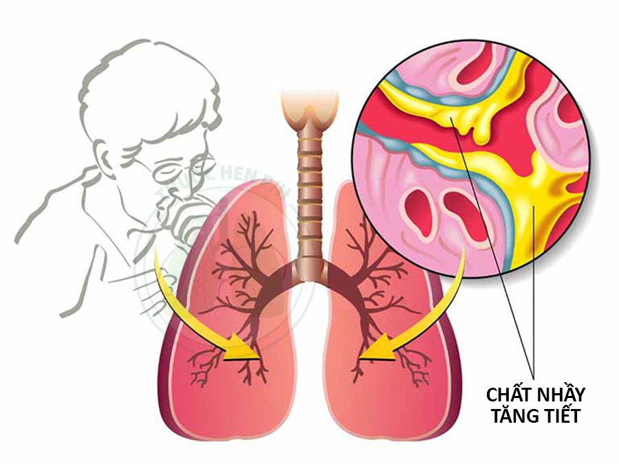 ho kèm khó thở khi vận động - Image 4
