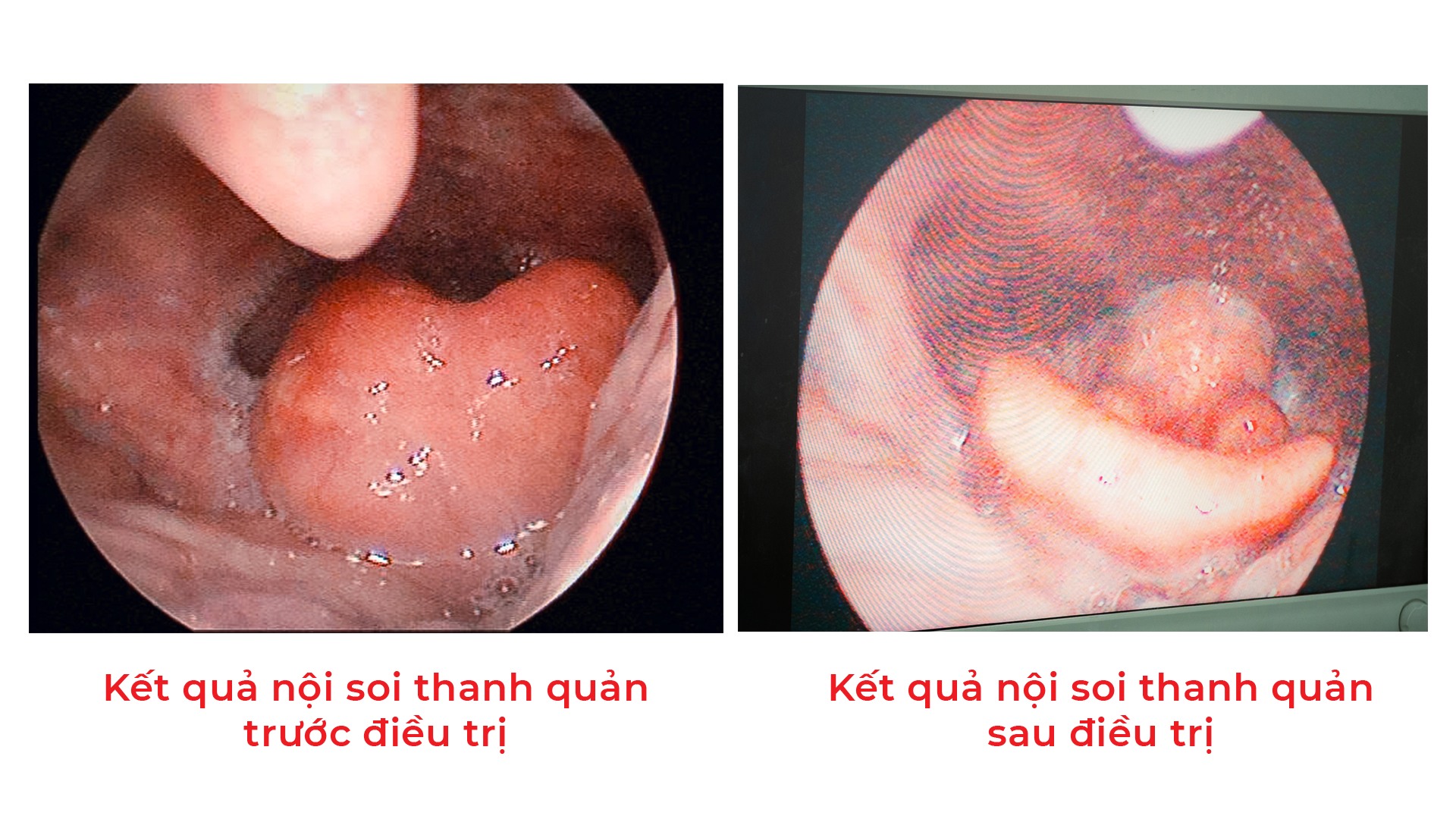 hóc xương cá chết - Image 1