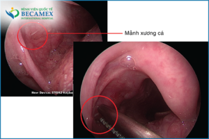 hóc xương cá có tự khỏi
