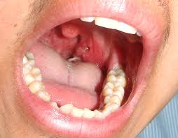 hóc xương cá có tự khỏi - Image 4