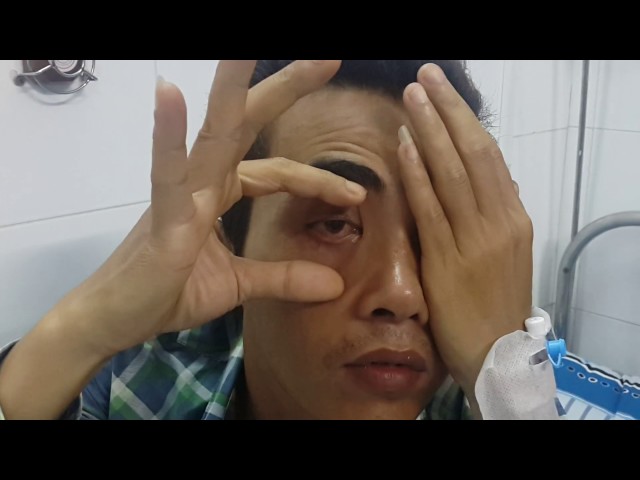 hội chứng đỉnh hốc mắt - Image 4