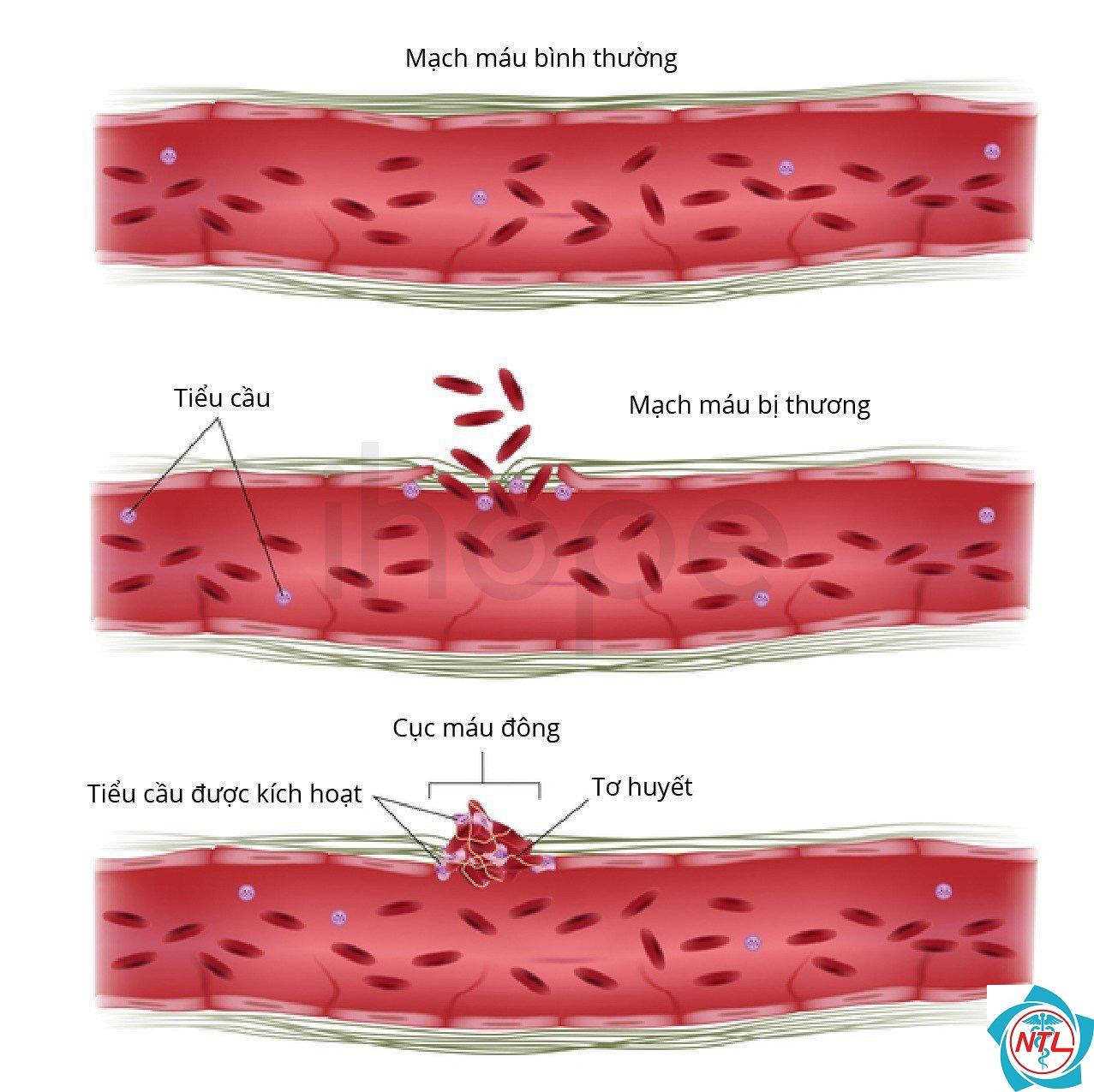 hội chứng urê huyết tán huyết - Image 5