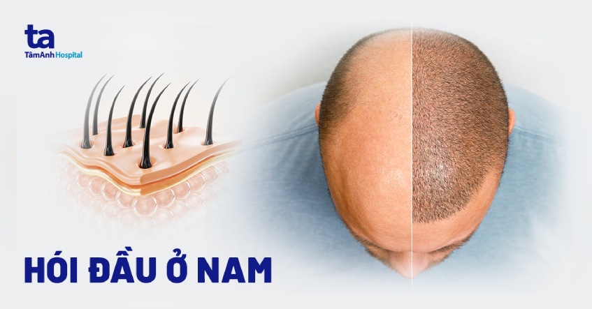 hói đầu nam giới - Image 5