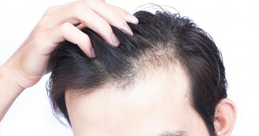 hói đầu ở nam giới trẻ tuổi