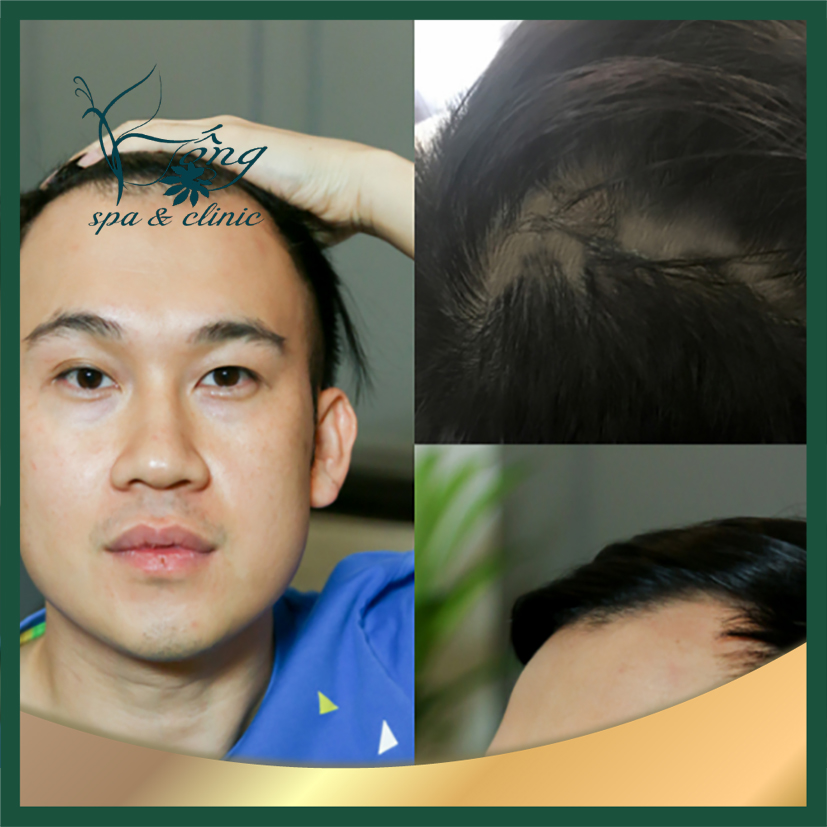 hói đầu ở nam giới trẻ tuổi - Image 2