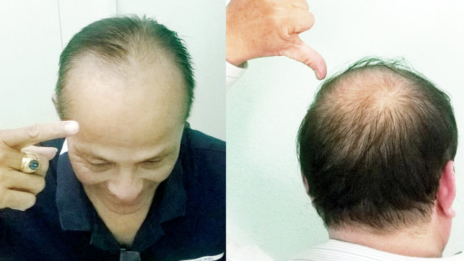 hói đầu ở nam giới trẻ tuổi - Image 3