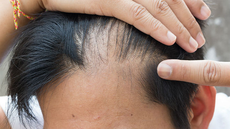 hói đầu ở nam giới trẻ tuổi - Image 4