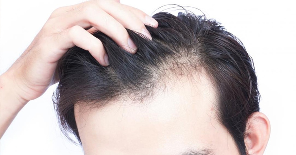 hói đầu ở nam giới trẻ tuổi - Image 1