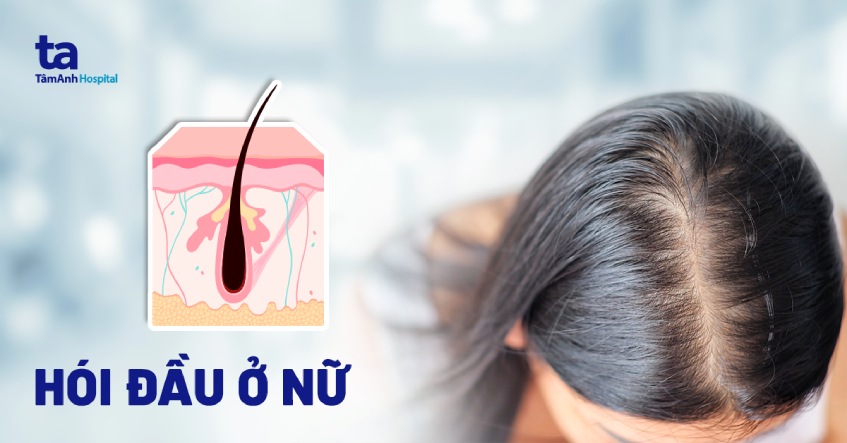 hói đầu ở phụ nữ - Image 2
