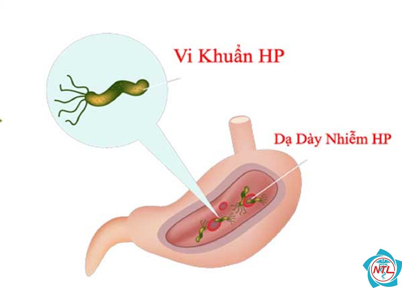 hp dạ dày - Image 3