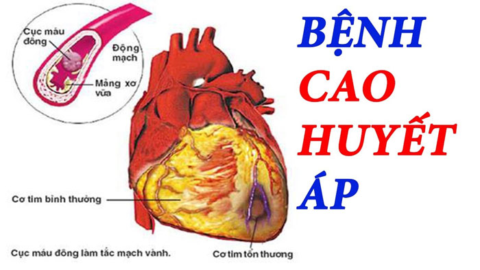 huyết áp cao và tim mạch - Image 3