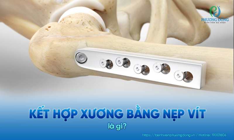 kết hợp xương bằng nẹp vít - Image 3