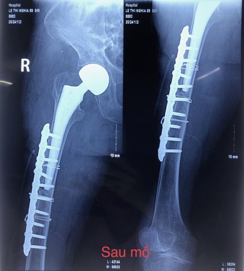 kết hợp xương bằng nẹp vít - Image 4