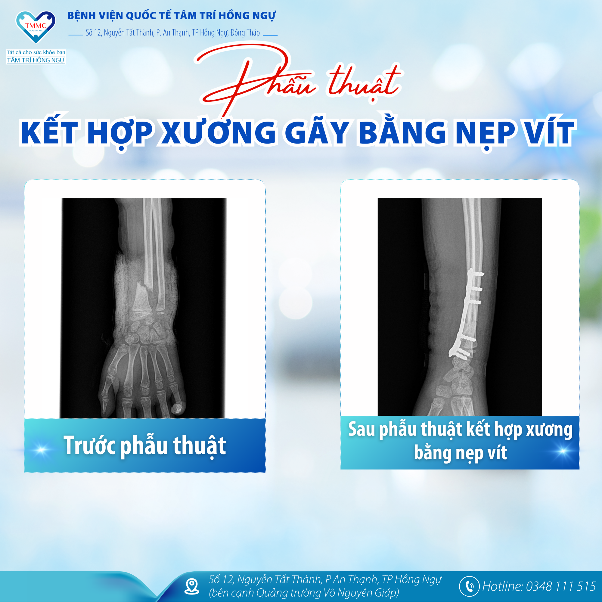 kết hợp xương bằng nẹp vít - Image 5