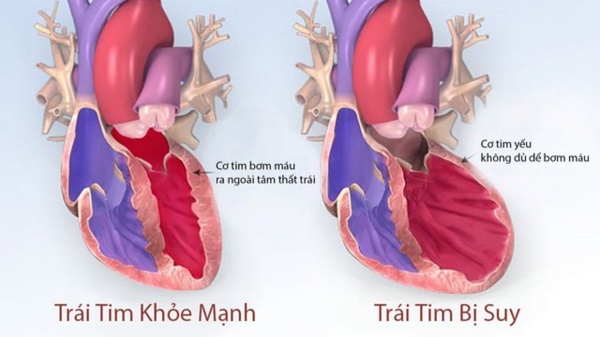 khi nào người suy tim cần nhập viện - Image 3