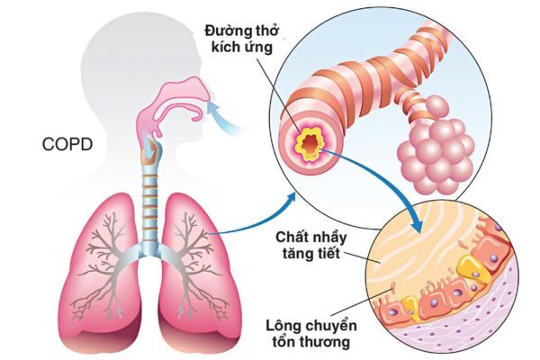 khó thở do copd - Image 5