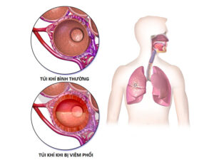 khó thở do phổi