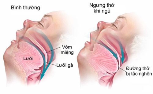 khó thở khi ngủ - Image 4