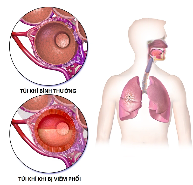 khó thở sau khi bị viêm phổi