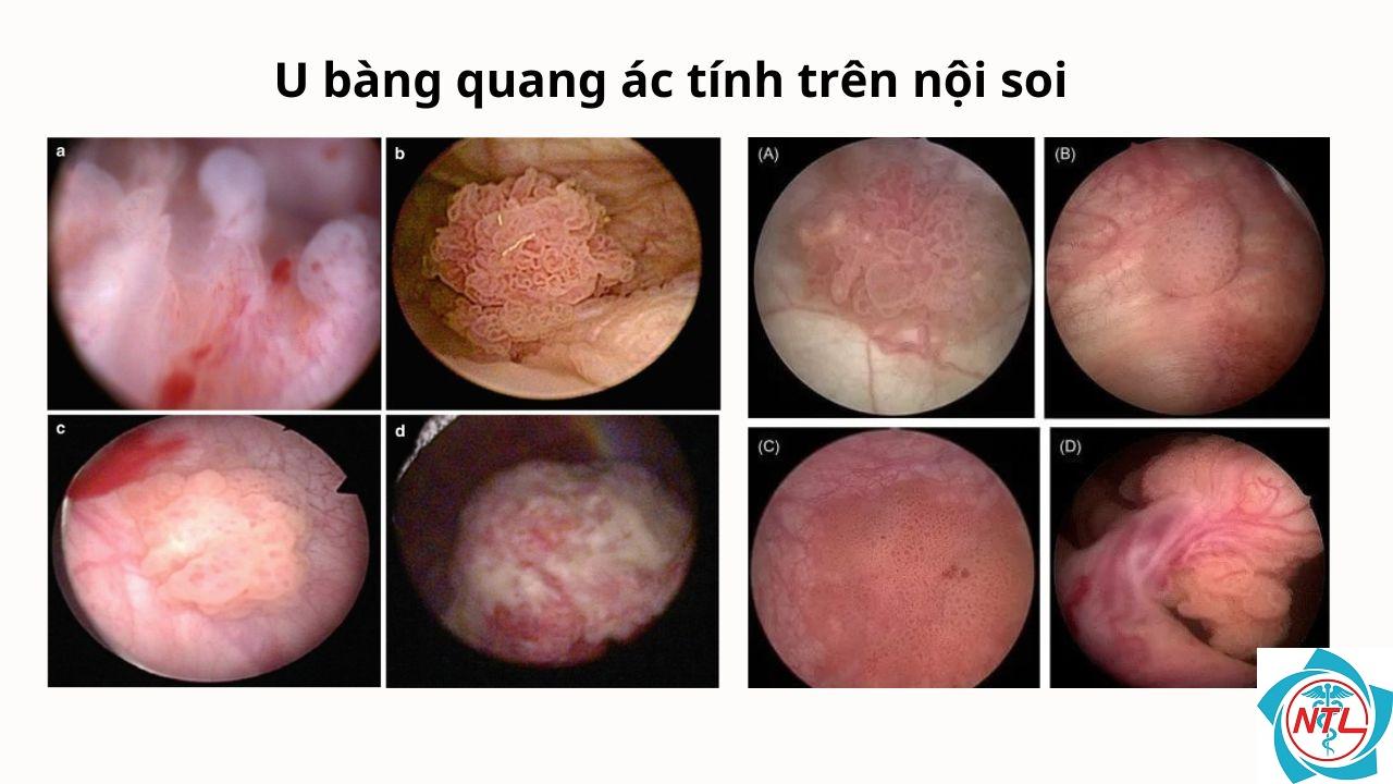 khối u bàng quang - Image 2