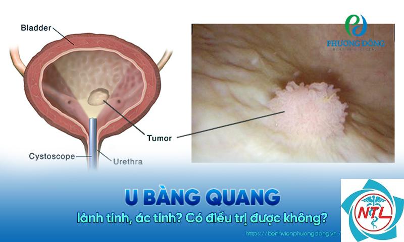 khối u bàng quang - Image 5