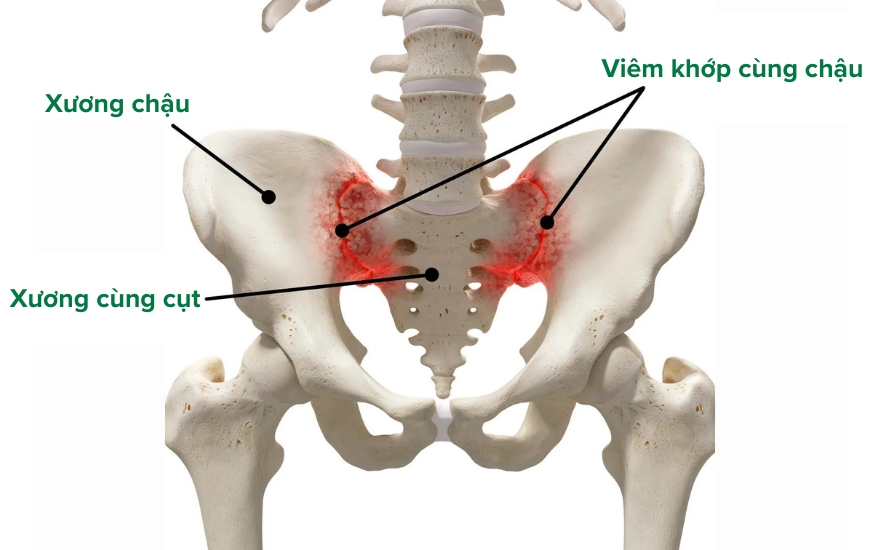 khớp cùng chậu - Image 2