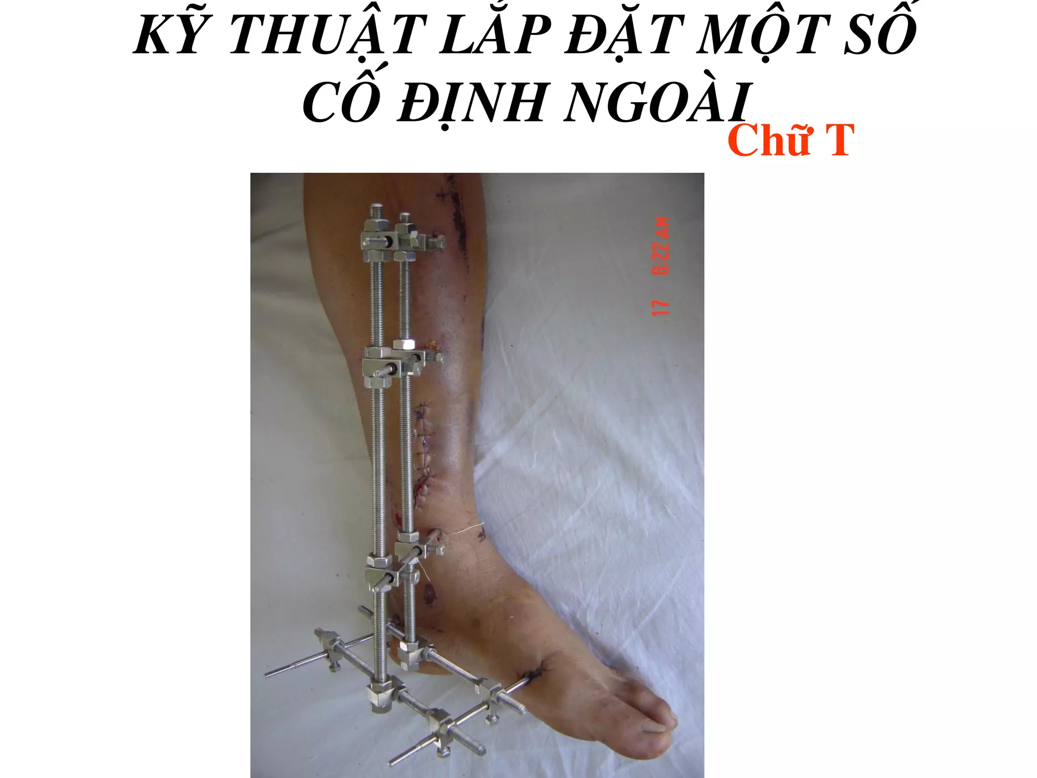 khung cố định ngoài cẳng chân - Image 5