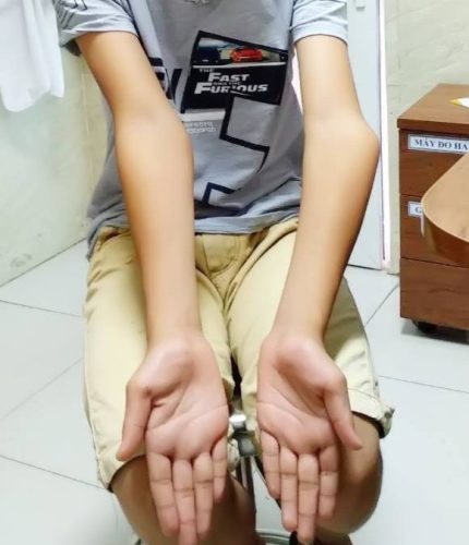 khuỷu tay bị cong