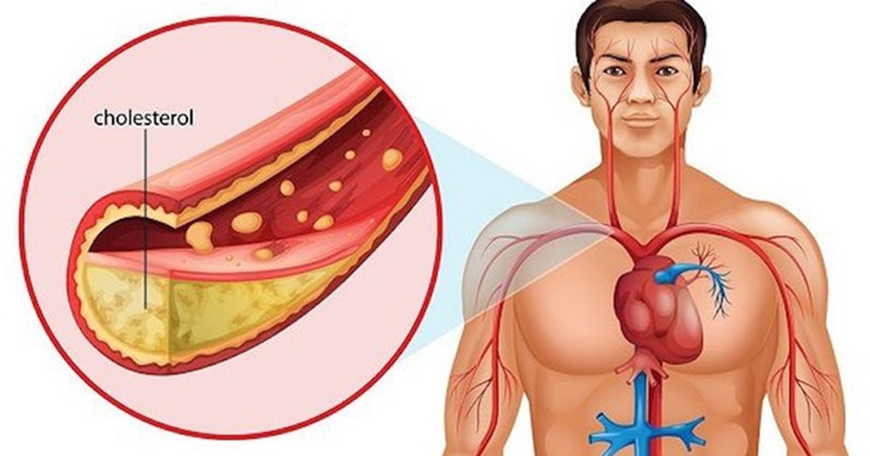 kiểm soát cholesterol