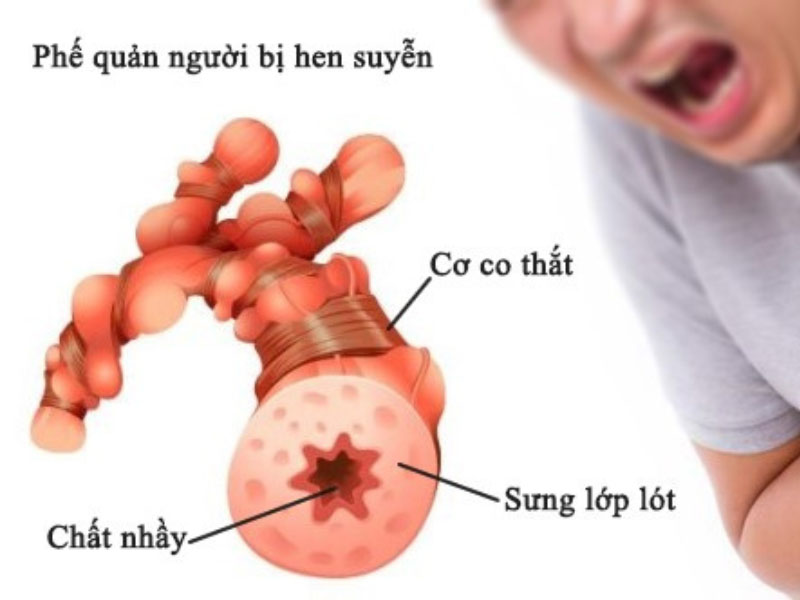 kiểm soát hen ở người trưởng thành - Image 3