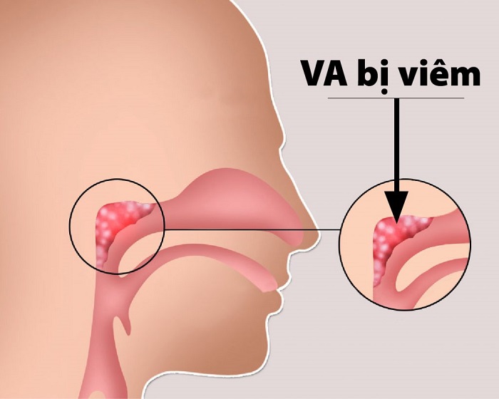 kinh nghiệm chữa viêm va cho bé - Image 1