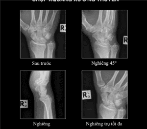 kỹ thuật chụp xương thuyền - Image 1