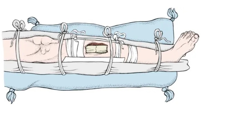 kỹ thuật cố định gãy xương - Image 5