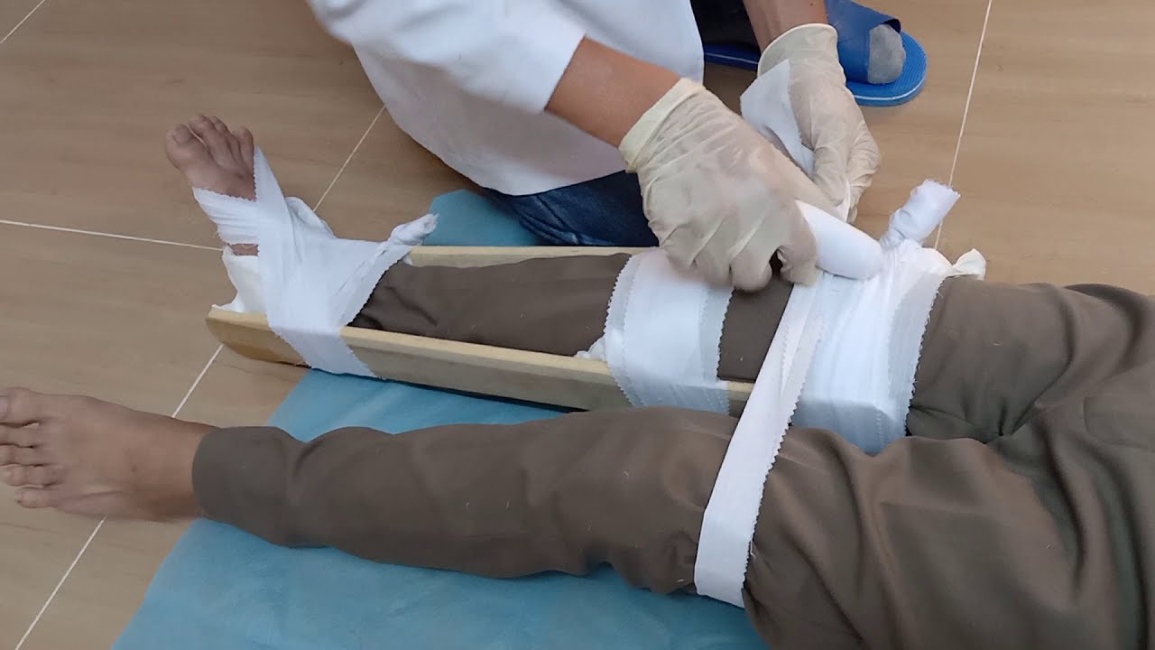 kỹ thuật cố định gãy xương cẳng chân - Image 4