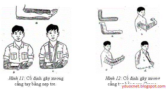 kỹ thuật cố định gãy xương