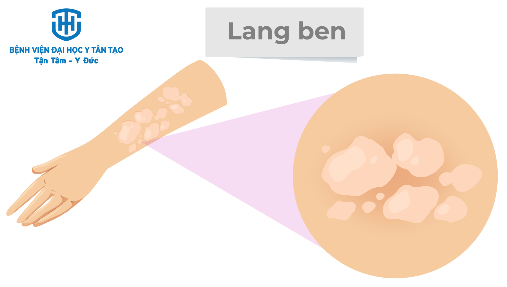 lang ben ở người ra nhiều mồ hôi - Image 3