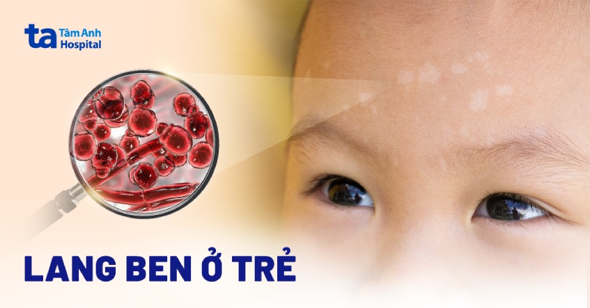 lang ben ở trẻ em