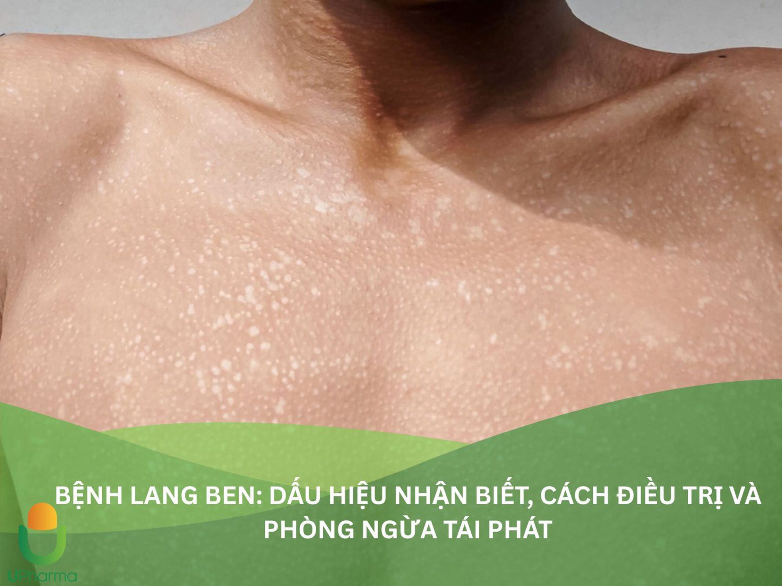 lang ben tái phát - Image 4