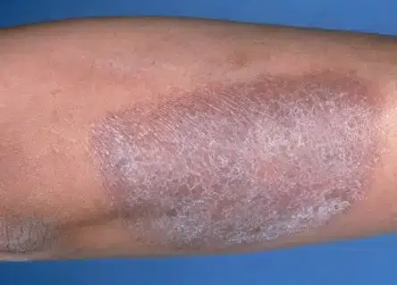 lichen đơn dạng mạn tính