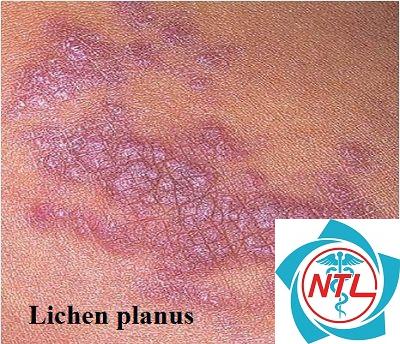 lichen phẳng - Image 5