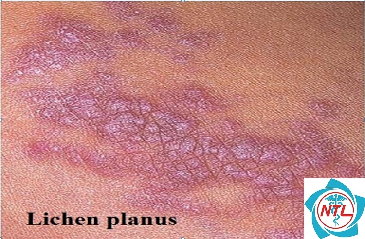 lichen phẳng da đầu - Image 5